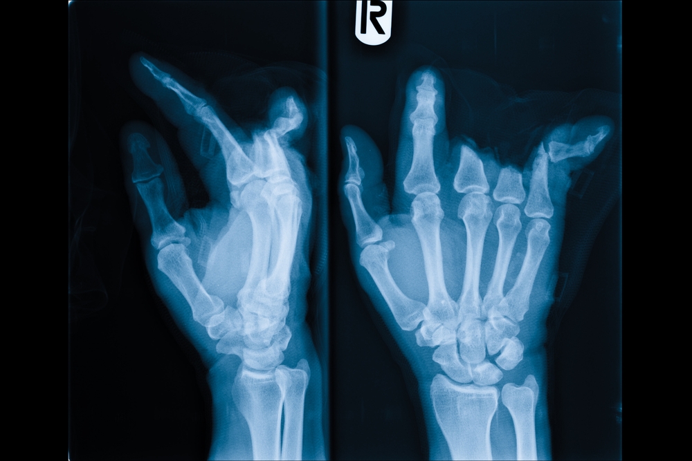 Finger amputation in Houston